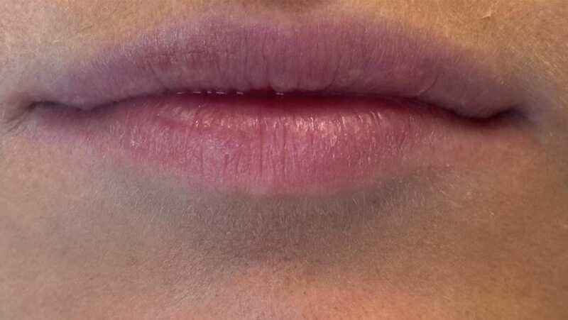 Before dental bridge treatment