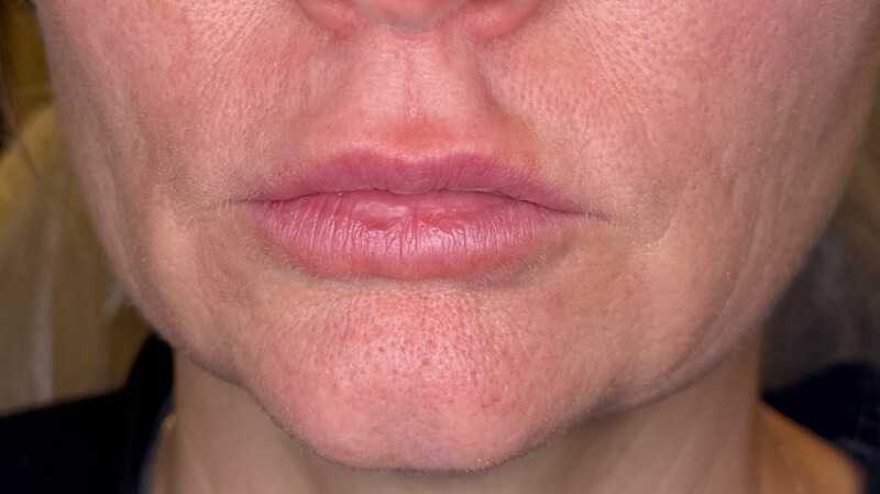 After treatment