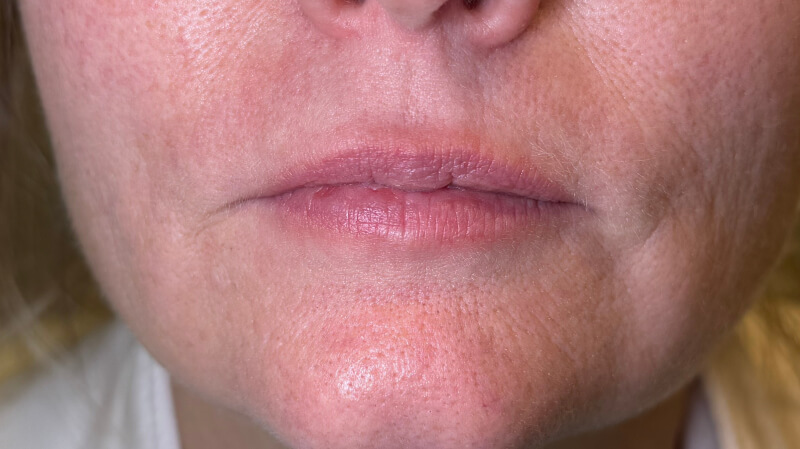 Before treatment