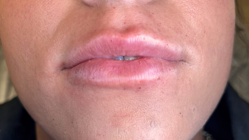 After treatment