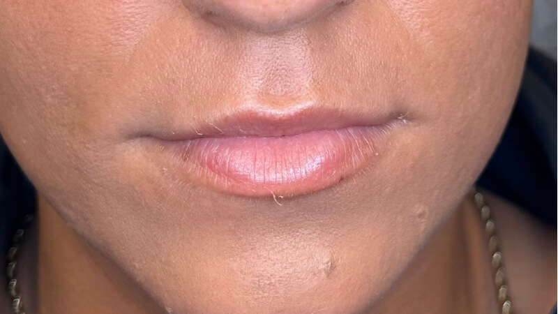 Before treatment