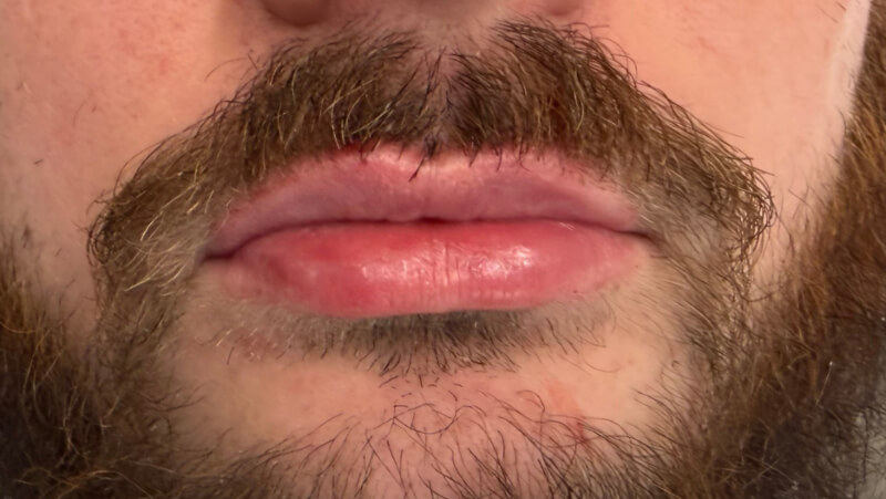 After treatment