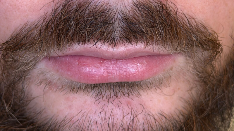 Before treatment