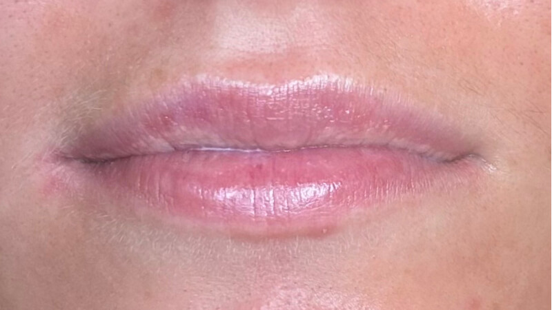 Before treatment