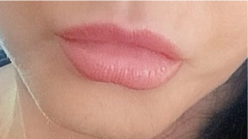 After treatment