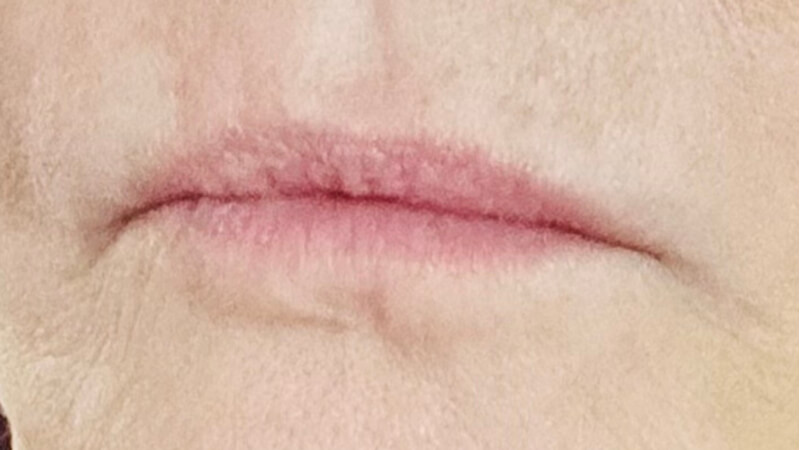 Before treatment