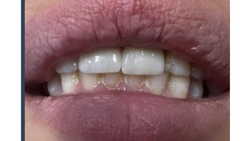 After dental bridge treatment