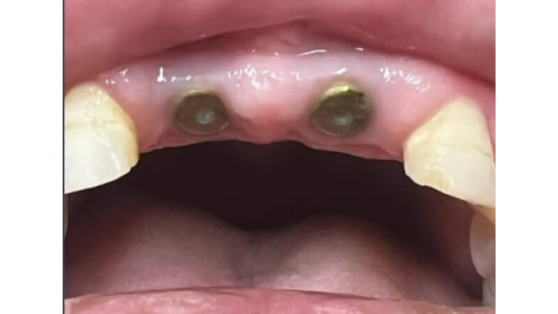 Before dental bridge treatment