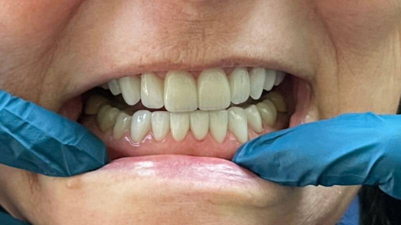 After dental bridge treatment