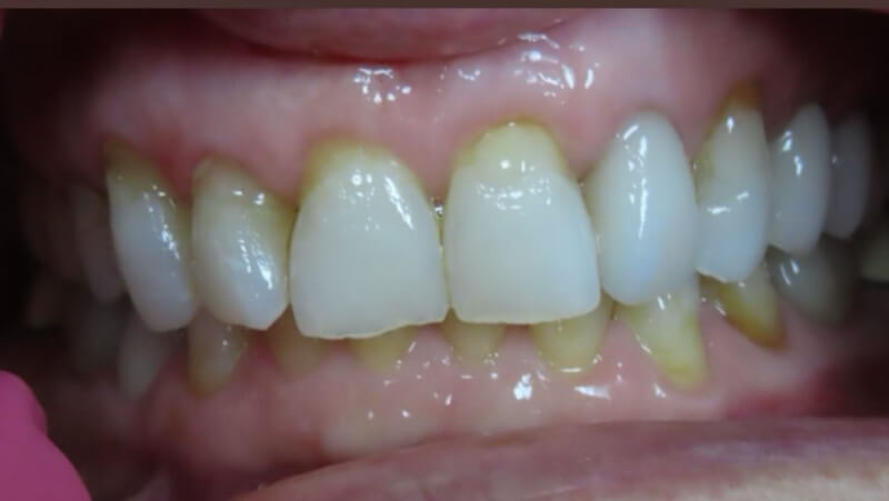 Before dental bridge treatment