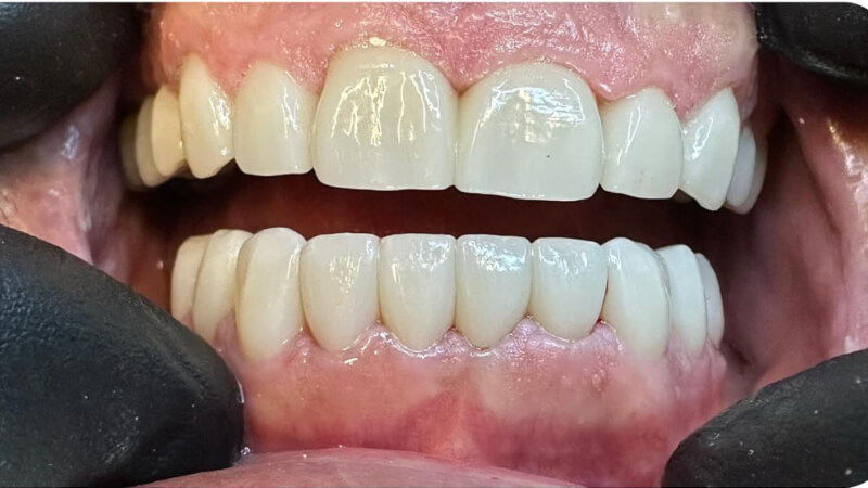 After treatment