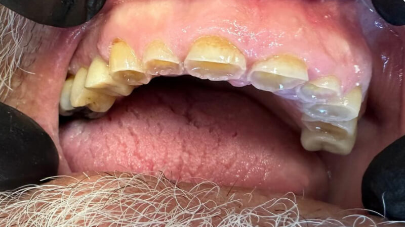 Before treatment