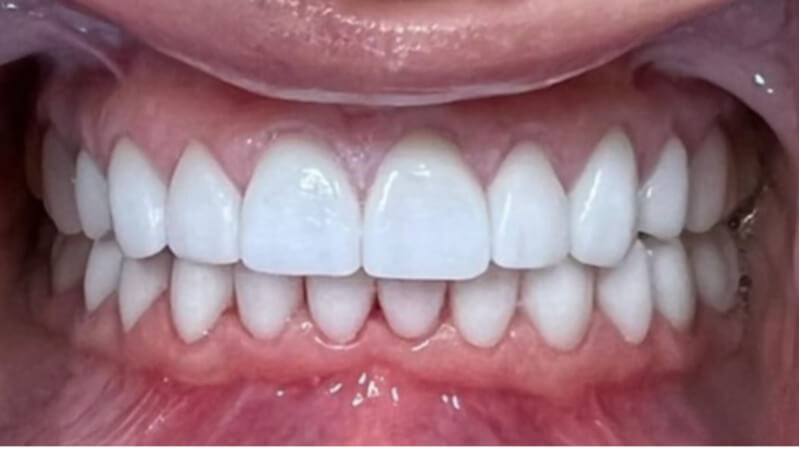 After treatment