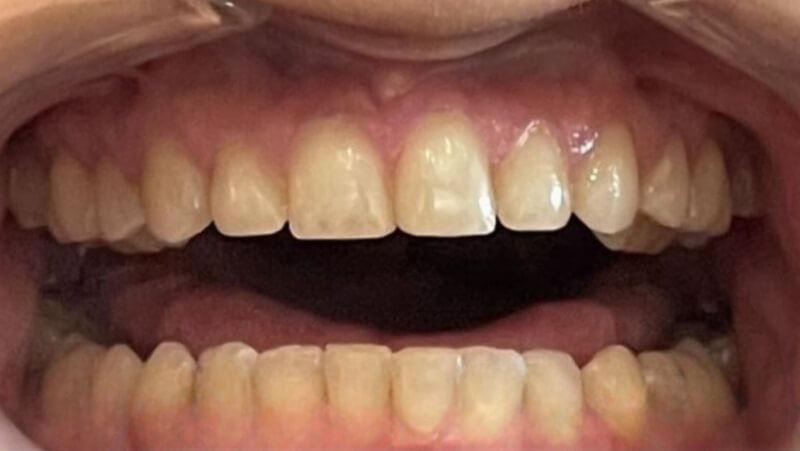 Before treatment
