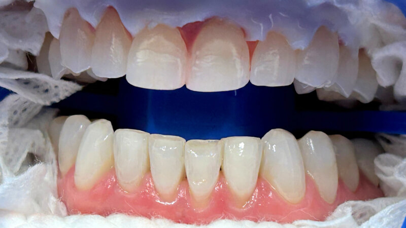 After dental bridge treatment