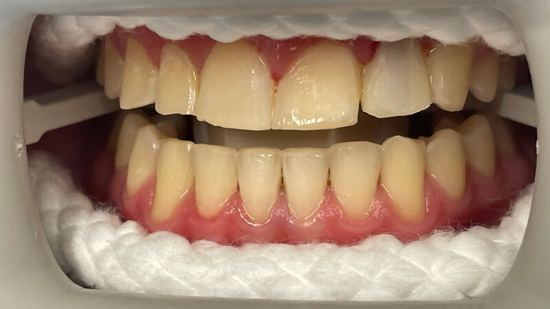 Before dental bridge treatment