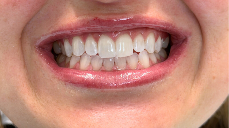 After treatment