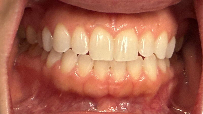 Before treatment