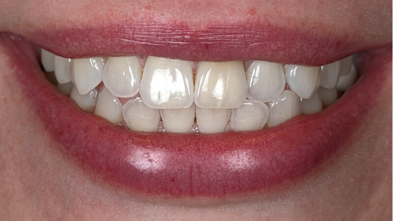 After treatment