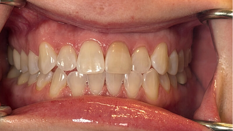Before treatment