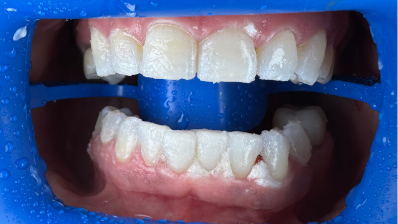 After treatment