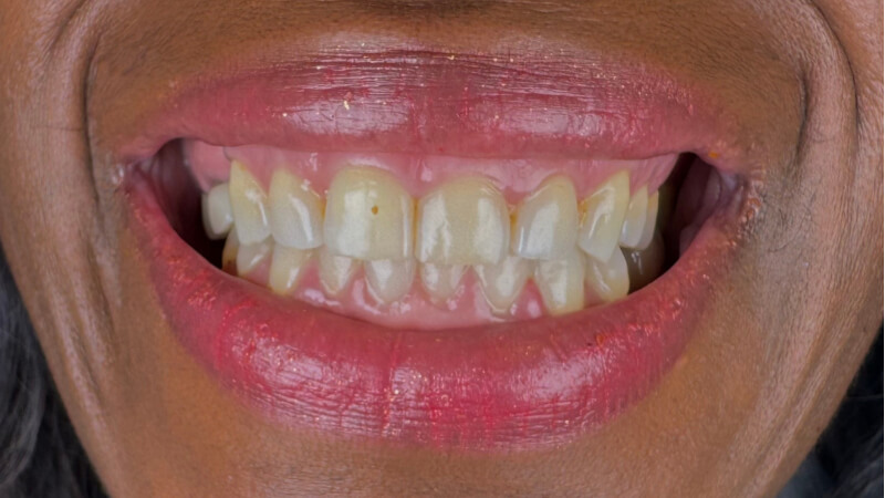 Before treatment
