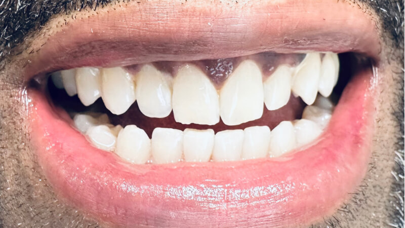 After treatment