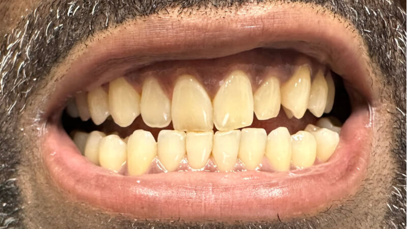 Before treatment