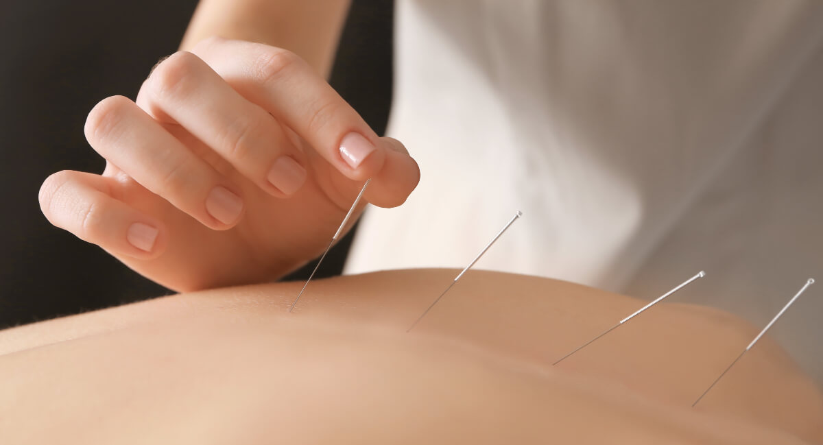 Acupuncture used on patient's back
