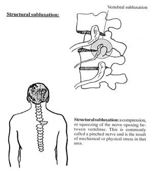 Structural Subluxation