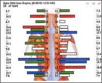 The different color bars indicate normal or nerve interference.