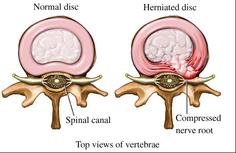 chiropractor for herniated discs in Springfield IL