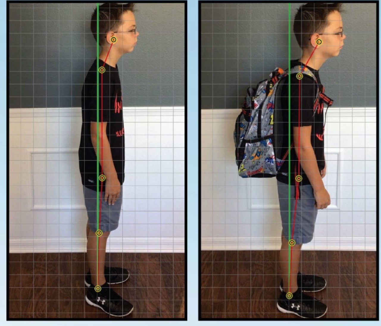 forward head posture before and after