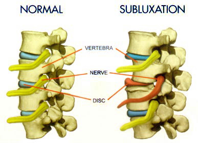 Subluxation