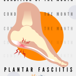 plantar fasciitis- july 2025