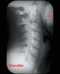 After Chiropractic Care