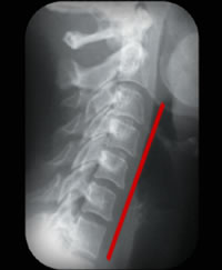Before Chiropractic Care