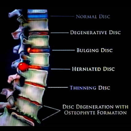 disc problems