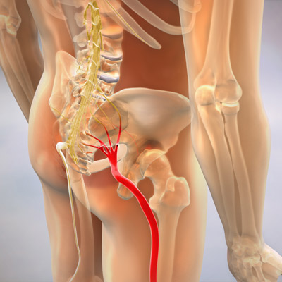 sciatica illustration