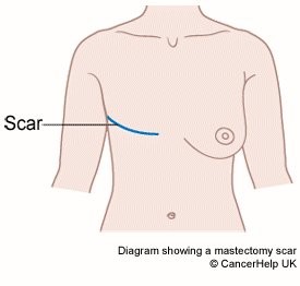 A diagram showing a post-mastectomy scar. Massage therapy treatments can help treat the scar tissue and prepare the area for reconstructive surgery.