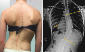 What Are the Different Types of Scoliosis Braces?