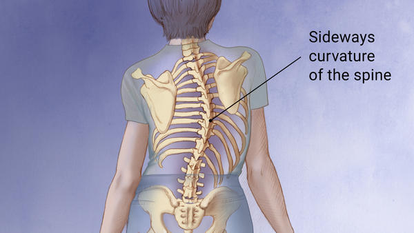 scoliosis image