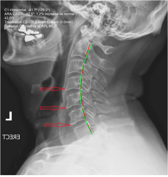 osteoarthritis neck