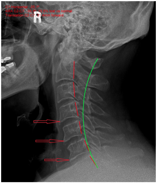 osteoarthritis neck