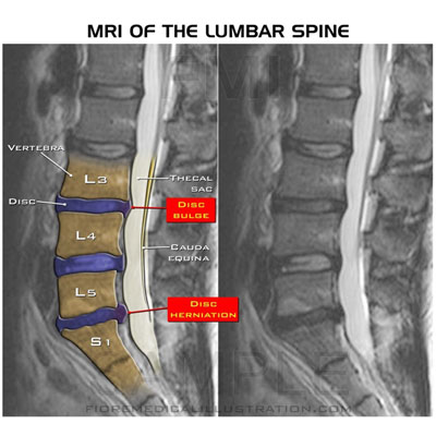 mri-of-lumbar-spine