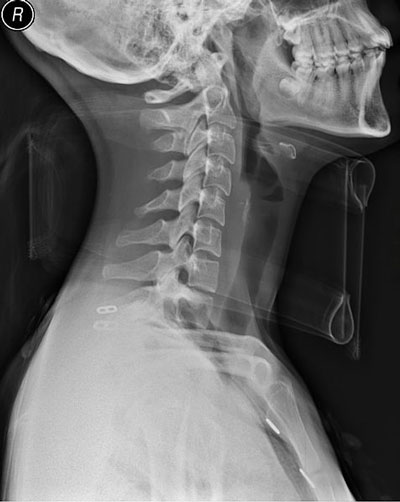 Neck X-Ray