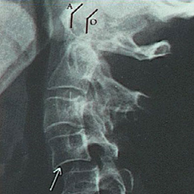 Spine x-ray