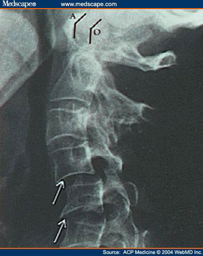 spinal-imbalance