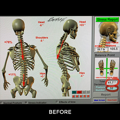 before-and-after-chiropractic-illustration