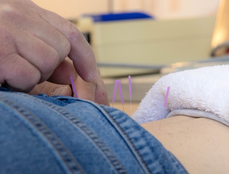 Acupuncture needles in Schultz Chiropractic & Acupuncture patients back